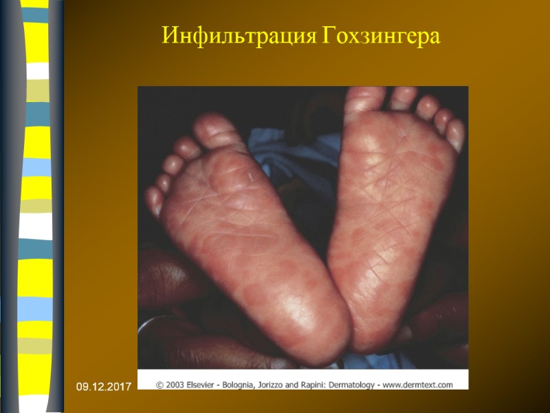 Инфильтрация Гохзингера 09.12.2017